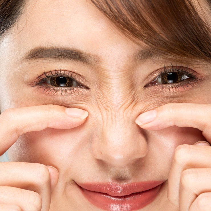 Person squeezing the skin on their nose with both hands, showing a close-up of eyes and nose, with a neutral facial expression.