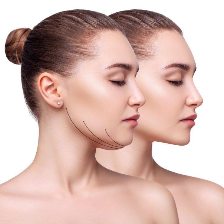 Side-by-side profile of a woman illustrating cosmetic changes to the chin and jawline, with lines indicating areas of enhancement.