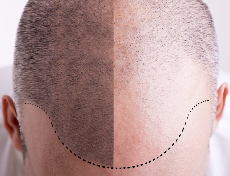 Close-up of a man's head showing a hair transplant result; the left side has hair grafts, while the right side is visibly bald with dotted lines indicating the surgery area.