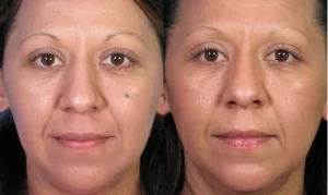 Side-by-side comparison of the same woman before and after a cosmetic procedure, showing smoother skin and reduced wrinkles in the after image.