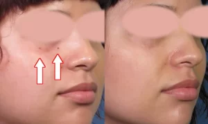 Before and after image showing a mole on a person's face removed. The left side shows the mole present, while the right side shows a smooth skin after removal.