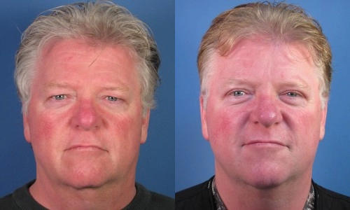 Before and after photos of a man with apparent skin treatment, showing reduced redness and smoother complexion.