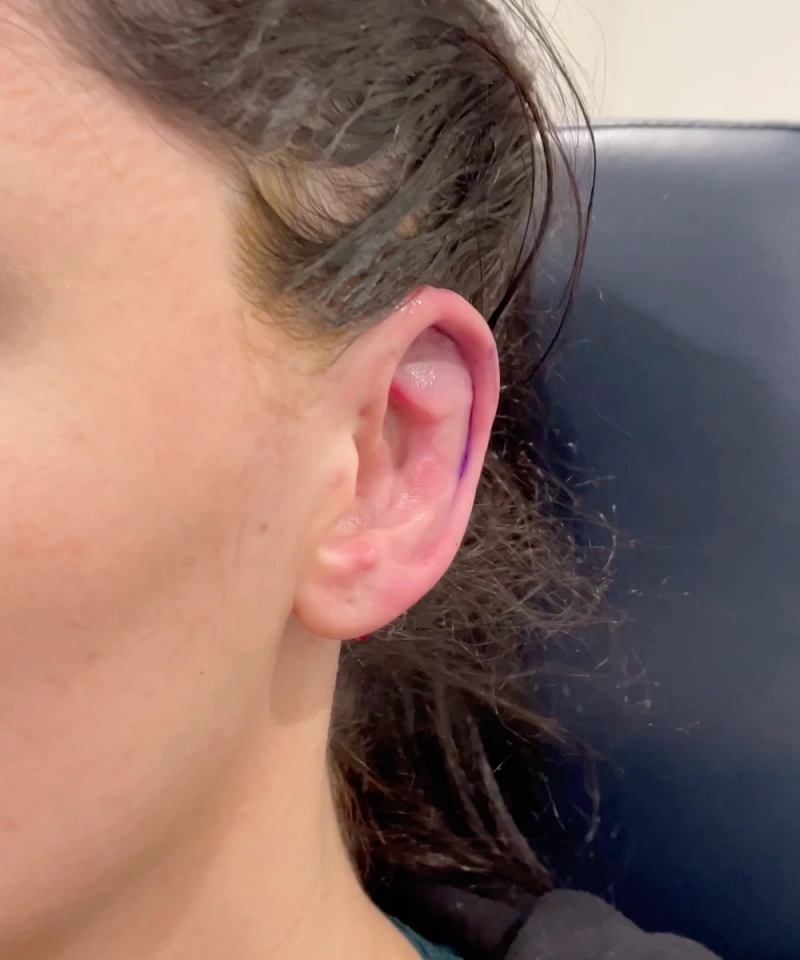 Close-up of a person's ear with redness and possible swelling around the upper ear, resting against a dark-colored chair.