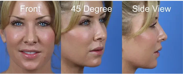 A woman is shown in three angles against a blue background: front, 45-degree, and side view.