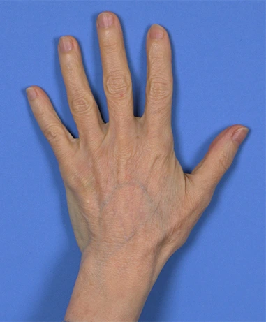 An adult left hand with fingers spread against a blue background.