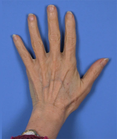 A left hand with fingers splayed against a blue background. A person wears a bracelet on the wrist.