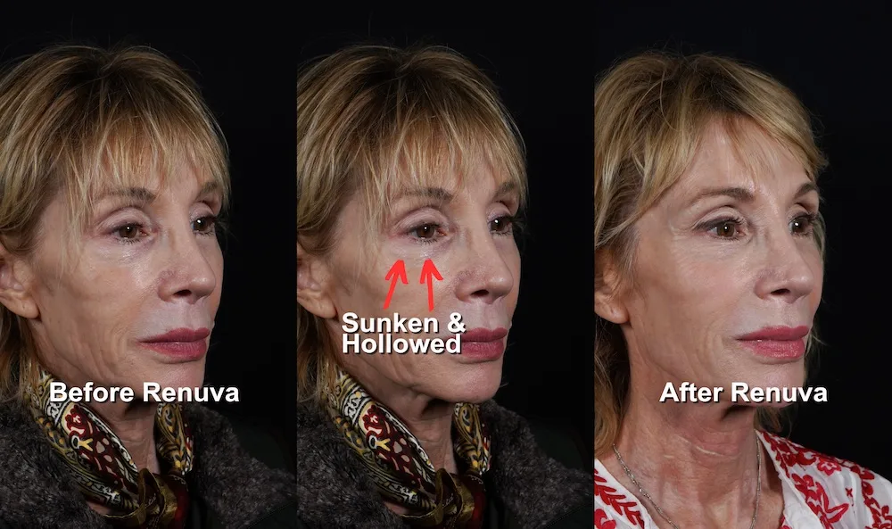 A woman’s face shown in three side-by-side photos labeled "Before Renuva," "Sunken & Hollowed," and "After Renuva," illustrating changes in facial volume.