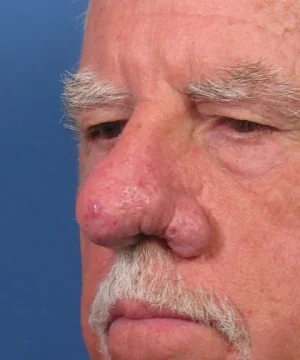 Close-up of an older man's face with a focus on his nose, showing textured and reddish skin. He has a mustache and light eyebrows against a blue background.