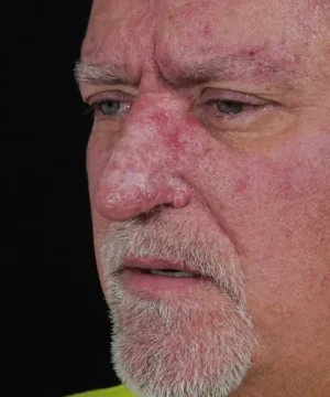 Close-up of an older man with a white beard and visible facial redness against a black background.