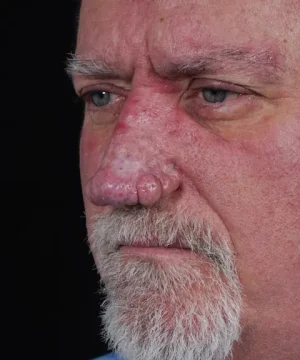 Close-up of a middle-aged man with a serious expression, showing a red, bumpy nose and a light beard against a dark background.