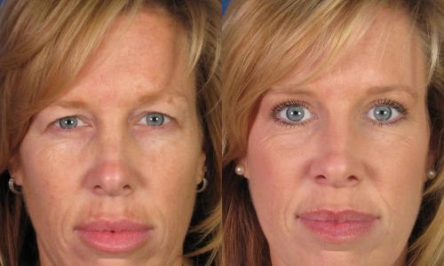 Side-by-side images of the same woman before and after a cosmetic procedure, highlighting changes in skin texture and facial features.