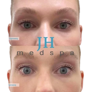 Before and after images of a person's eyes, showing increased eyelid lift in the lower image.