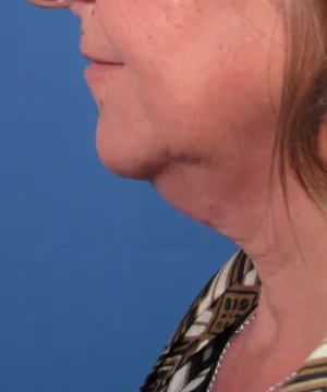 Profile view of a person's lower face and neck against a blue background. The person has light skin and is wearing a patterned shirt.