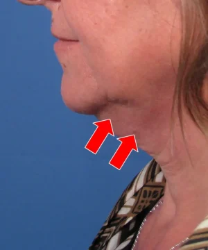 A side profile of a person's face and neck with two red arrows pointing at the chin area, highlighting the lower jawline.