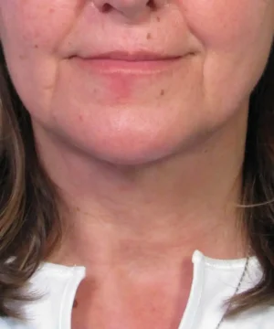 Close-up of a person’s lower face and neck, highlighting skin texture and a white high-collared top.