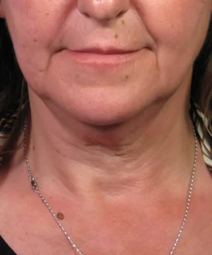 A person with light skin showing their lower face, neck, and part of a necklace.