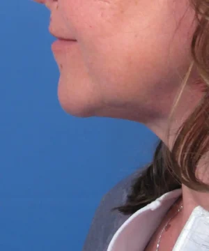 Side profile of a person with curly brown hair, focusing on the neck and jawline, against a blue background.