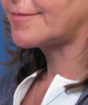 Close-up of a woman's lower face and neck, showing some skin texture and a partial smile.