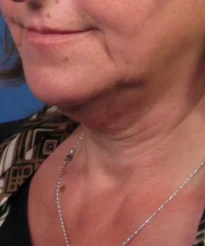 Close-up of a woman's lower face and neck showing wrinkles and skin texture. She wears a necklace and a patterned garment.