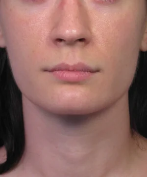 Close-up of a person's lower face and neck with neutral expression.