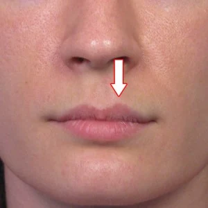 Close-up of a person's lips with a red downward arrow pointing to the philtrum, the groove between the nose and upper lip.