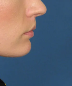 Close-up side profile of a person's face against a blue background, showing the nose, lips, and a portion of the chin.