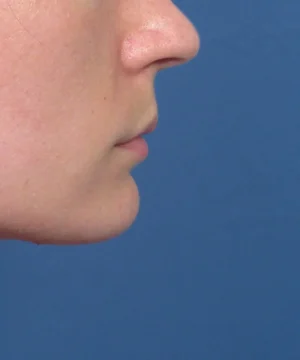 Profile view of a person's face against a blue background, focusing on the nose and lips.