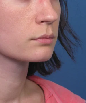 Close-up of a person's face in profile view, with subtle blemishes on the cheek. The person has short brown hair and is wearing a pink top. The background is solid blue.