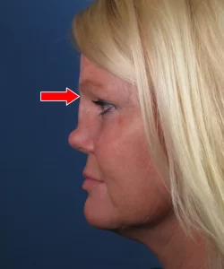 Profile view of a person with long blonde hair, showing a red arrow pointing to the forehead area against a blue background.