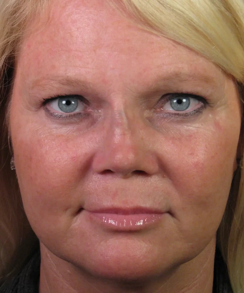 Close-up of a person's face with light skin and blue eyes, looking directly at the camera.