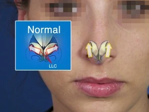 Diagram showing a frontal view of nasal airflow in a human nose, with arrows indicating airflow direction. Labels include "Normal" and "LLC.