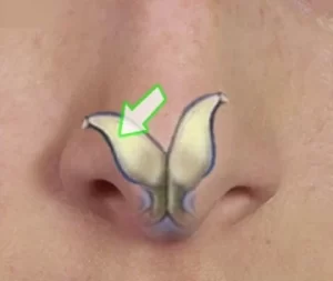 Close-up of a nose with a butterfly-wing diagram overlay, pointing to the areas of the nostrils.