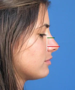 Profile view of a woman's face against a blue background, with lines drawn measuring the angle of her nose.