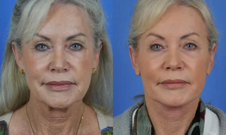 Two images side by side showing an older woman before and after a cosmetic procedure, with noticeable changes in skin texture and facial features.