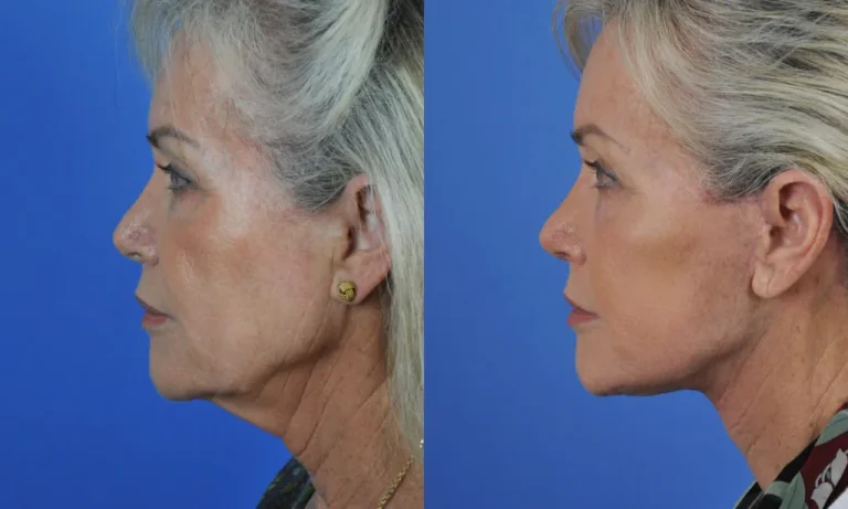 Side-by-side profile photos of an older woman before and after cosmetic treatment, showing reduced wrinkles and a tightened jawline against a blue background.