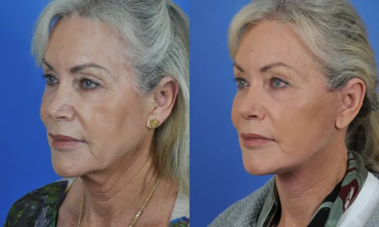 Side-by-side comparison of a woman showing before-and-after effects of a cosmetic procedure. The left image depicts more wrinkles, while the right image appears smoother and more youthful.