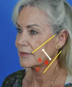 Profile of a woman with facial lines and angles labeled A, B, and C against a blue background.