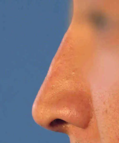 Close-up of a person's nose from the side against a plain blue background.