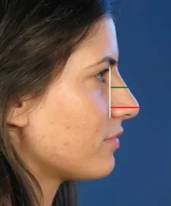 Profile view of a person's face with lines measuring nose angles, set against a blue background.