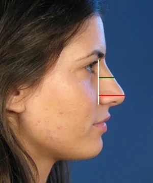 Profile view of a woman's face with lines illustrating nose proportions against a blue background.