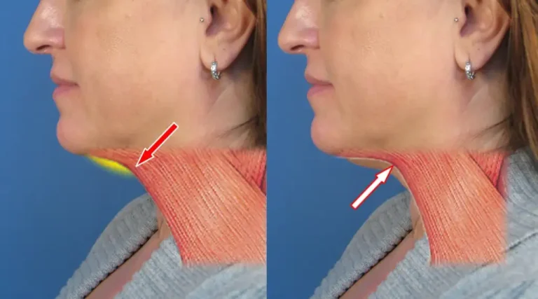 Side view comparison of a woman's neck before and after a cosmetic procedure, highlighting muscle structure and skin texture improvements with red arrows.