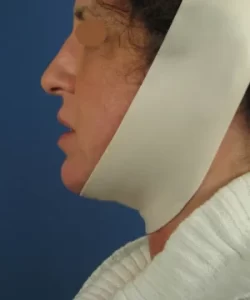 A person wearing a white compression garment around their jaw and head, against a blue background.