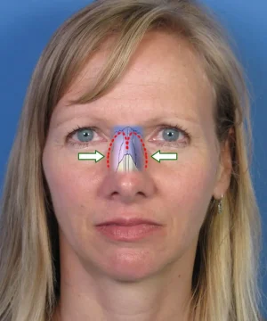 Image of a woman with arrows and dotted lines on her nose, indicating areas potentially for surgical adjustment.