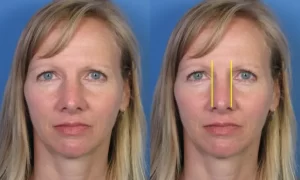 Side-by-side images of a woman with blond hair against a blue background. The right image has two yellow lines across her nose.