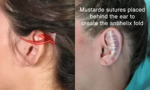 Two images of an ear: left shows an arrow indicating the antihelix area; right shows Mustarde sutures behind the ear for antihelix fold formation.