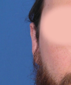 Close-up of a person's side of the face with a blurred area and blue background.