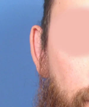 Close-up of the right side of a person's face with a blurred area, showing an ear and part of a beard against a blue background.