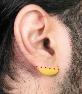 Close-up of a person's ear with a yellow ear-shaped object attached to the earlobe, marked with red dots.