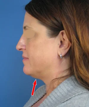 Profile of a person with long brown hair, wearing a gray top. An arrow points to the chin area against a blue background.