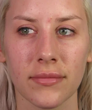 A person with light skin and blonde hair shows their face with visible redness, acne, and uneven skin tone. The lips are closed and eyes are looking slightly to the side.